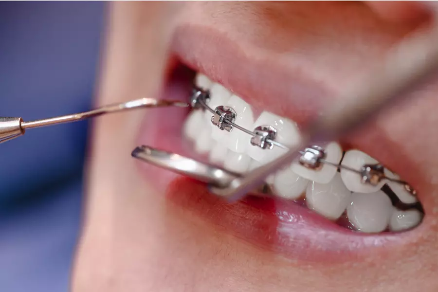 Orthodontic Treatment